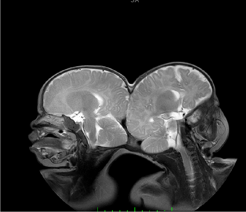 An MRI scan of two craniopagus twins, showing their brains.