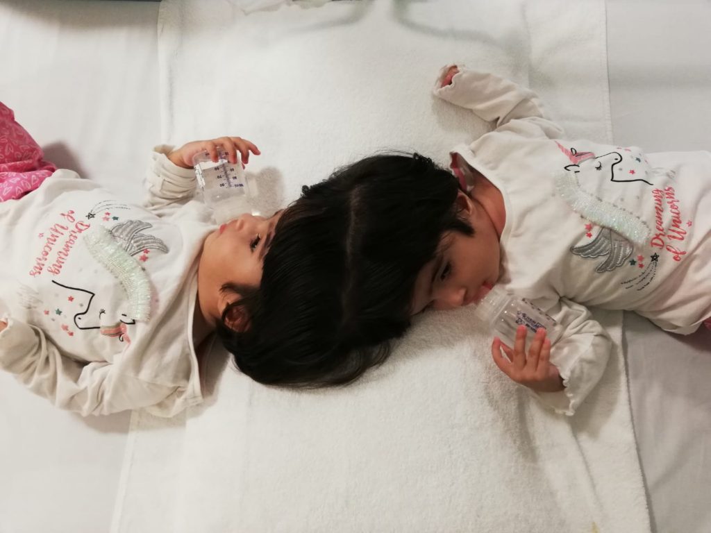 Safa and Marwa, craniopagus twins, lie on a bed pre-operation.