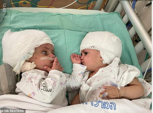 The Israeli craniopagus twins lying on a hospital bed post-operation.