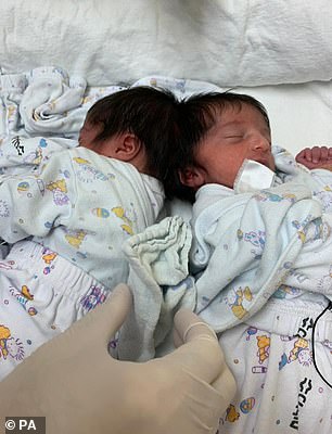 The Israeli craniopagus twins before their surgery.
