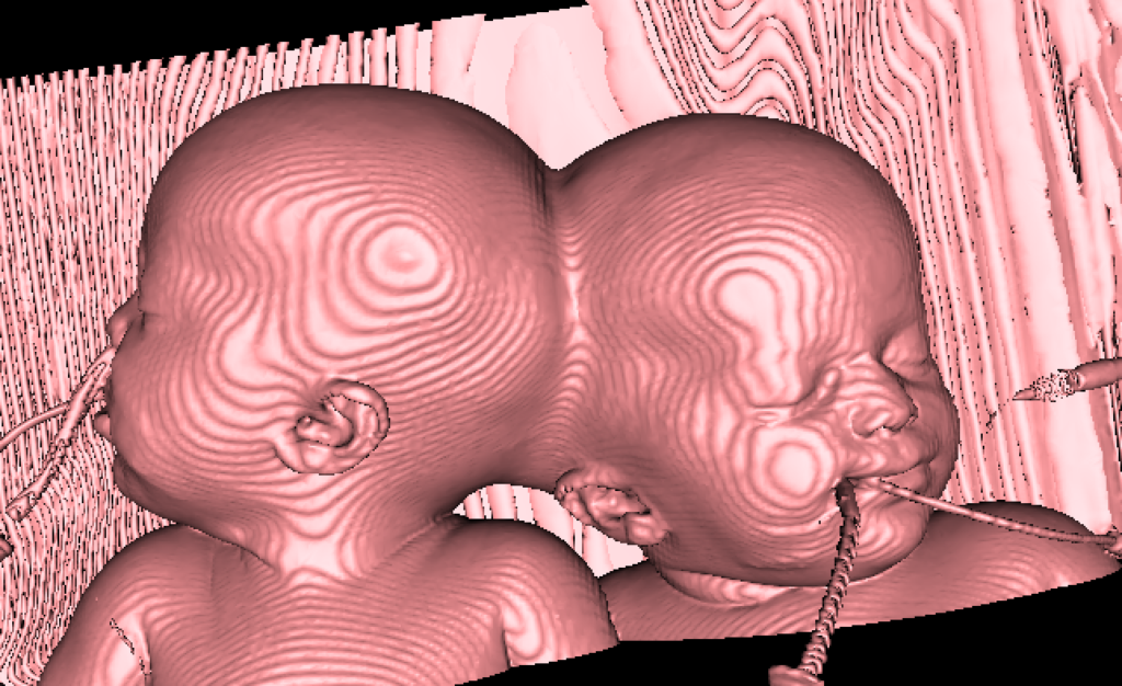 A 3d render of the Israeli craniopagus twins.